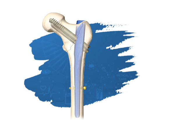 Intertan Intramedullary Nail