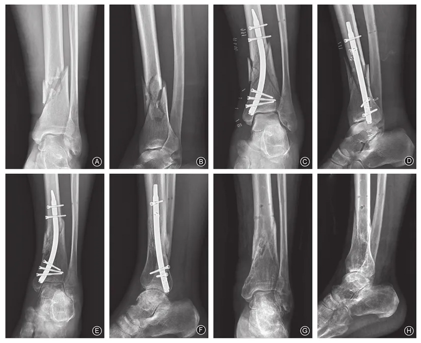 Surgical Procedure Visualization - Distal Tibial Nailing Technique