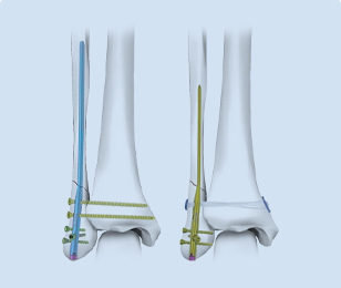 Expert-Fibular-Intramedullary-Nail