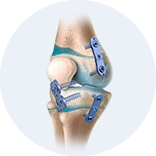 Expert Femoral Intramedullary Nail