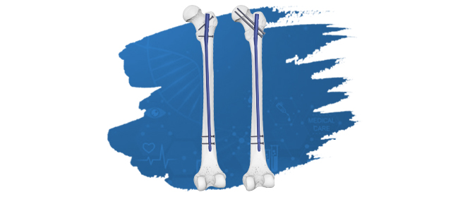 Expert Femoral Intramedullary Nail