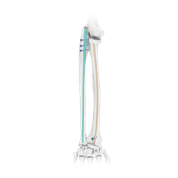 Intradmedullary Nail