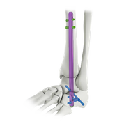 Intradmedullary Nail