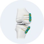 Expert Femoral Intramedullary Nail