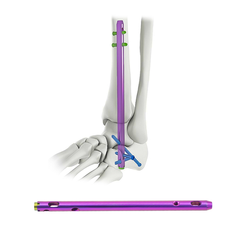 Hindfoot Fusion Ankle Nail