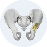 Expert Femoral Intramedullary Nail