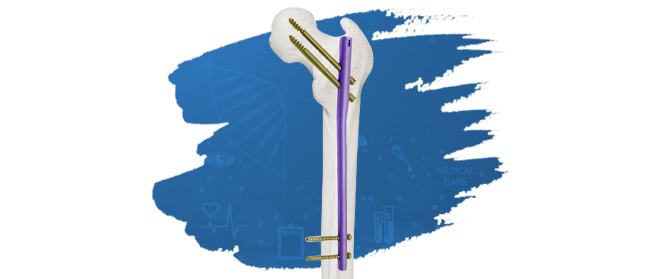 Gamma Intramedullary Nail