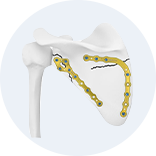 Expert Femoral Intramedullary Nail