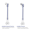 Expert Femoral Intramedullary Nail