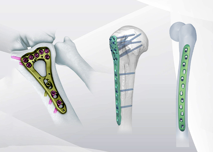 LOCKING PLATE SYSTEM