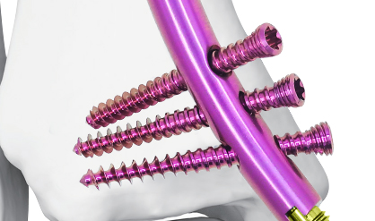 Distal Tibial Intramedullary Nail (DTN)