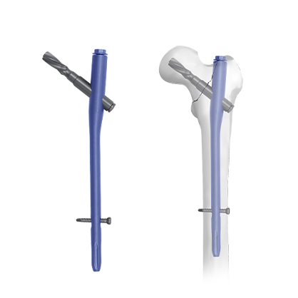 Retrograde Intramedullary Nailing for Distal Tibial Periankle Fractures: Technical Highlights And Clinical Value