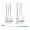 Expert Fibular Intramedullary Nail