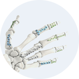 Expert Femoral Intramedullary Nail