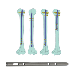 Humeral Intramedullary Nail (Blade Type)