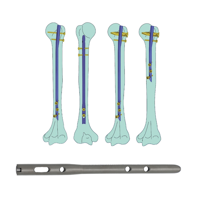 Humeral Intramedullary Nail (Blade Type)