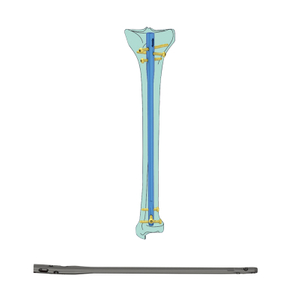 Suprapatellar Approach Tibial Intramedullary Nail