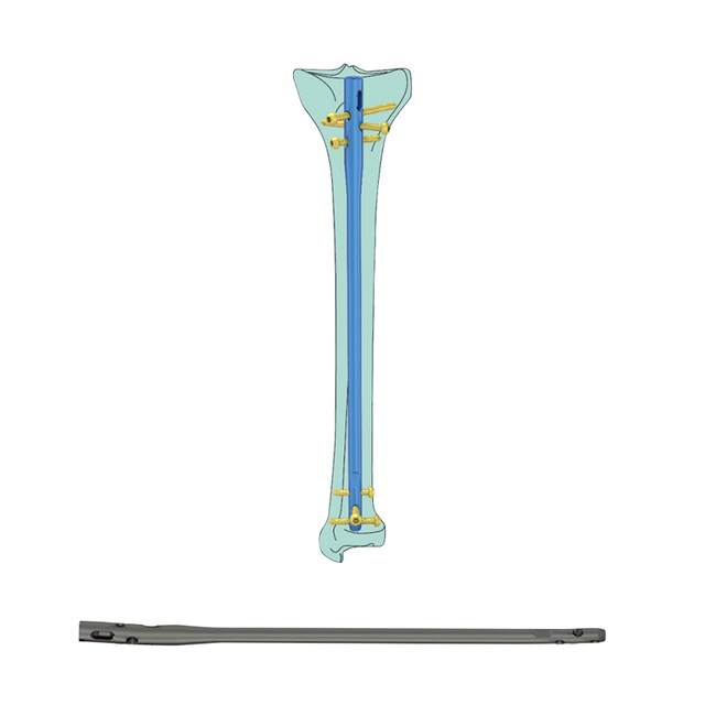 Suprapatellar Approach Tibial Intramedullary Nail