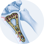 Expert Femoral Intramedullary Nail