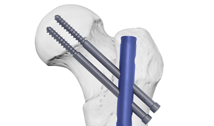 Expert Femoral Intramedullary Nail Box