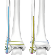 Intradmedullary Nail