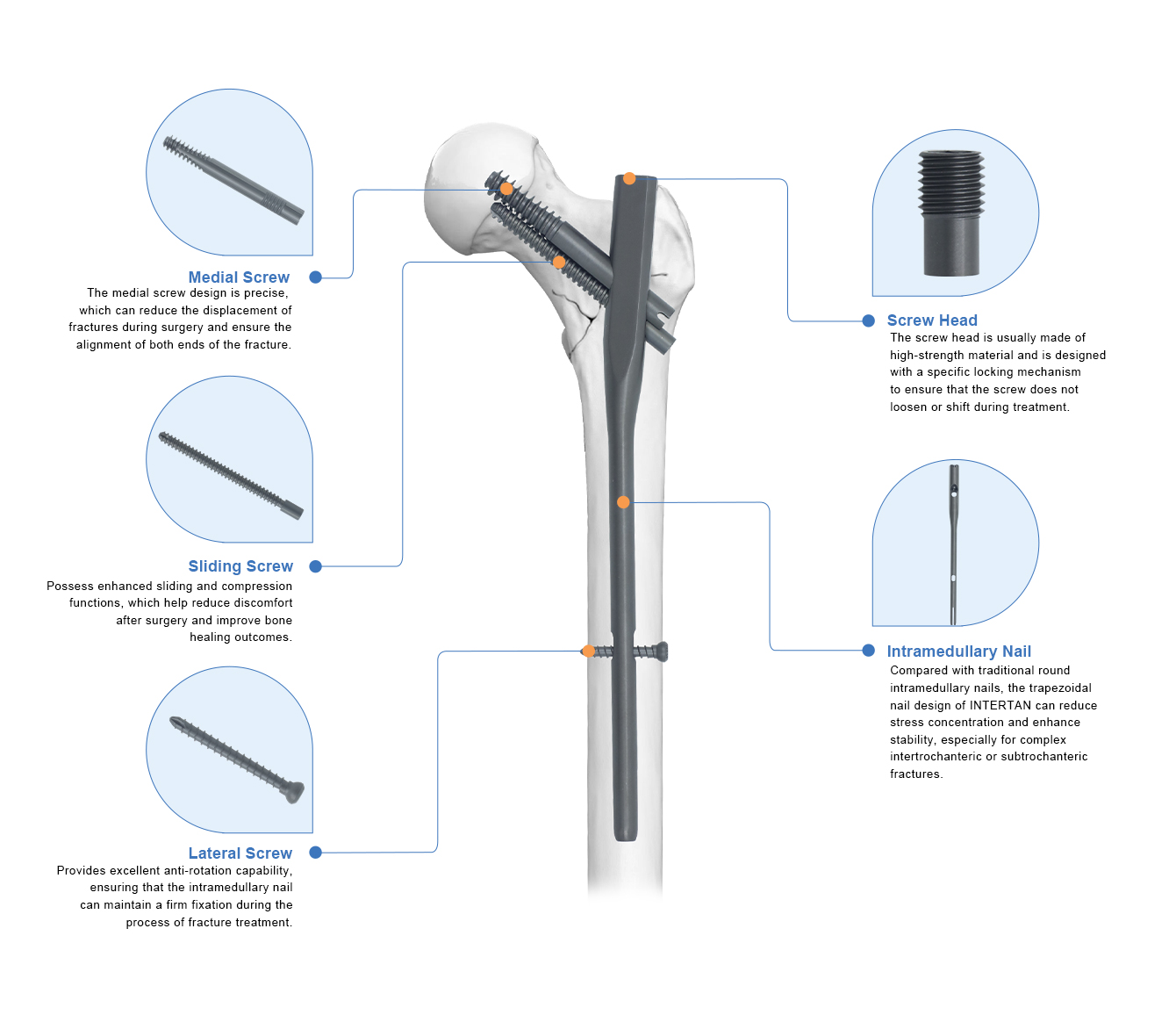 Intertan Intramedullary Nail