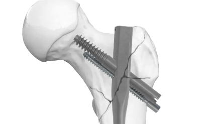 Intertan Intramedullary Nail