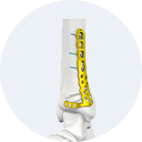 Expert Femoral Intramedullary Nail