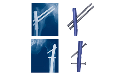 Expert Femoral Intramedullary Nail Box