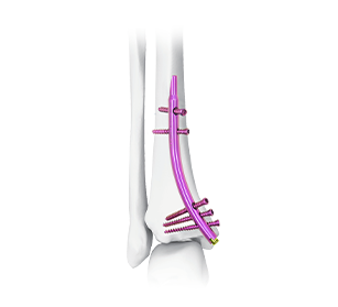 Distal Tibial Nail Visualization