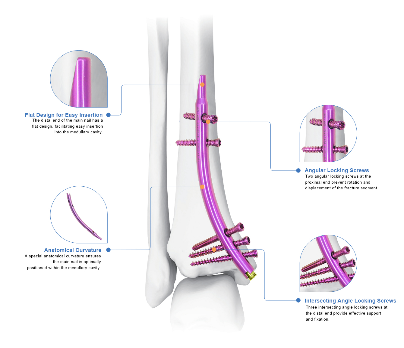 Distal Tibial Intramedullary Nail (DTN)